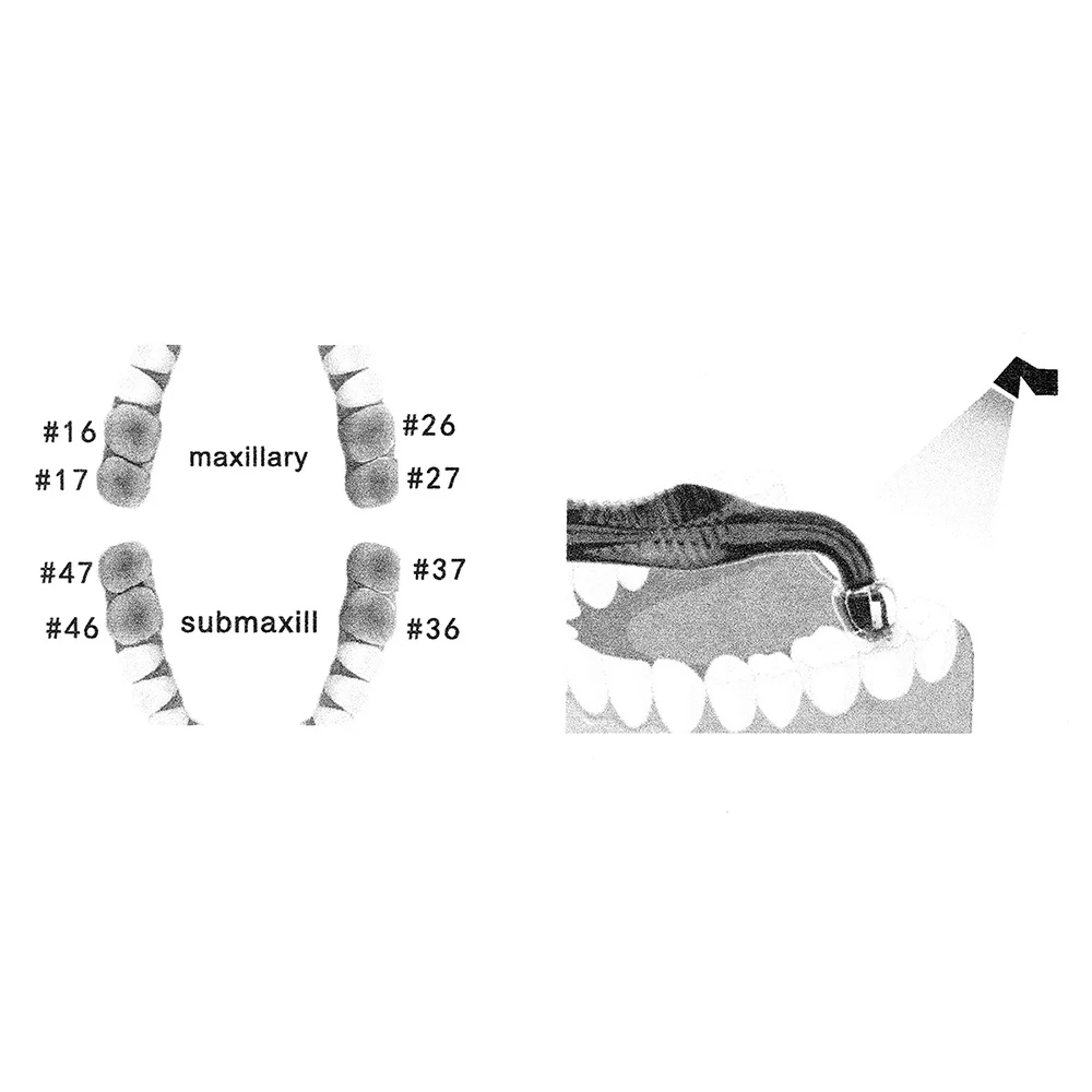 Dental Orthodontic Posterior T - 3D Printing Orthodontics avis et prix